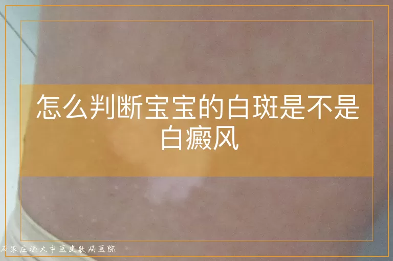 怎么判断宝宝的白斑是不是白癜风