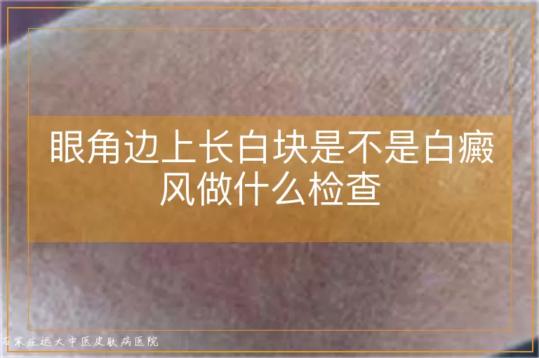 眼角边上长白块是不是白癜风做什么检查