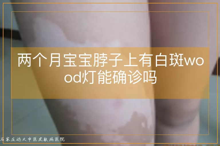 两个月宝宝脖子上有白斑wood灯能确诊吗