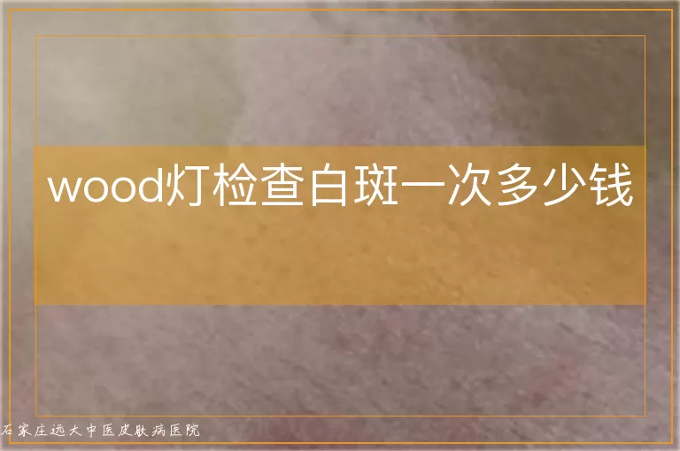 wood灯检查白斑一次多少钱