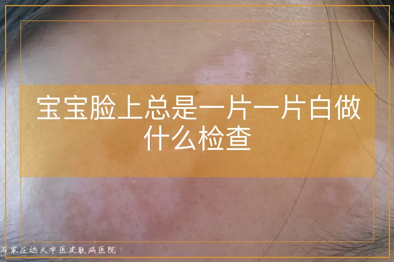 宝宝脸上总是一片一片白做什么检查