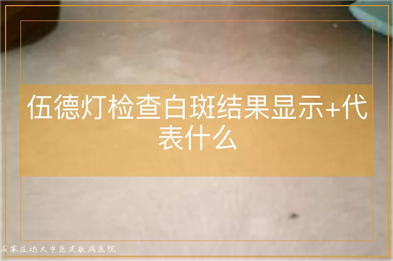 伍德灯检查白斑结果显示+代表什么