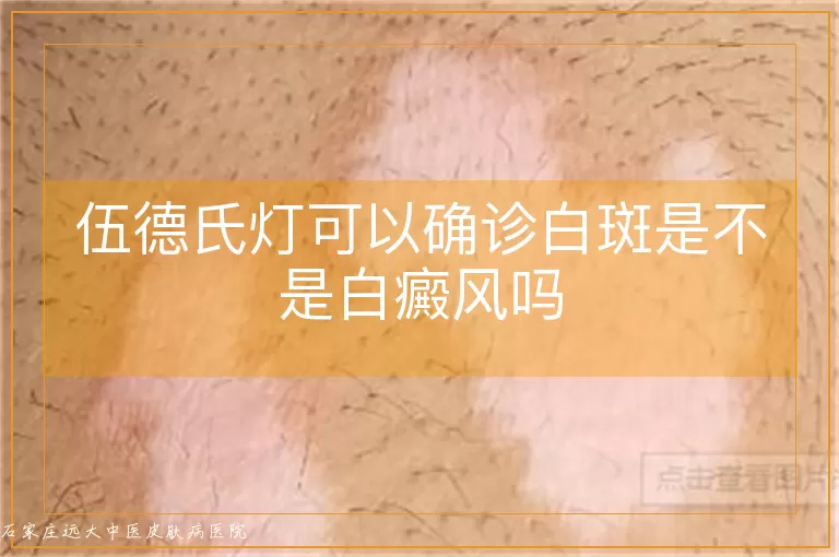 伍德氏灯可以确诊白斑是不是白癜风吗