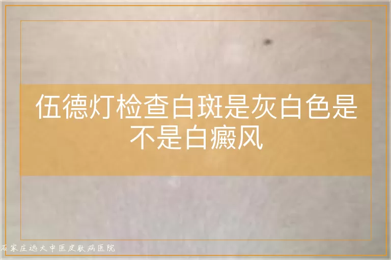伍德灯检查白斑是灰白色是不是白癜风