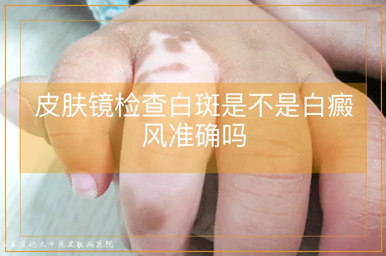 皮肤镜检查白斑是不是白癜风准确吗