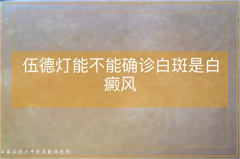 伍德灯能不能确诊白斑是白癜风