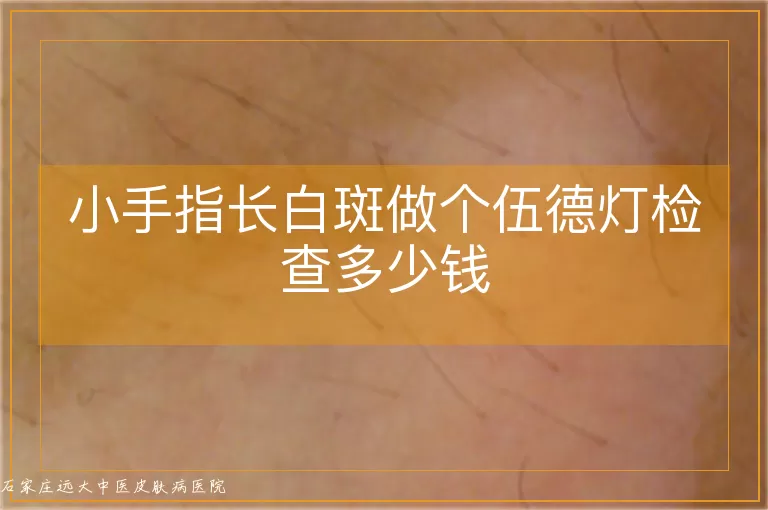 小手指长白斑做个伍德灯检查多少钱