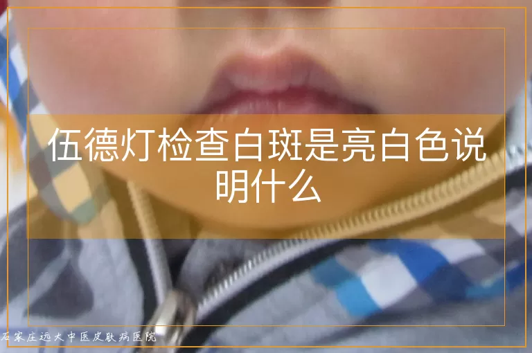 伍德灯检查白斑是亮白色说明什么