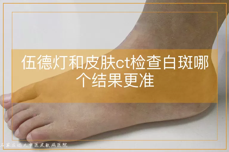 伍德灯和皮肤ct检查白斑哪个结果更准