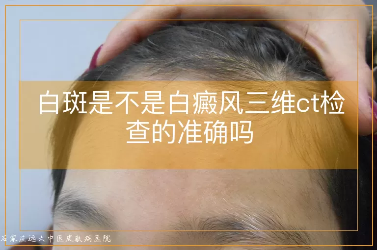 白斑是不是白癜风三维ct检查的准确吗