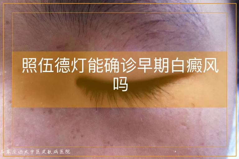 照伍德灯能确诊早期白癜风吗