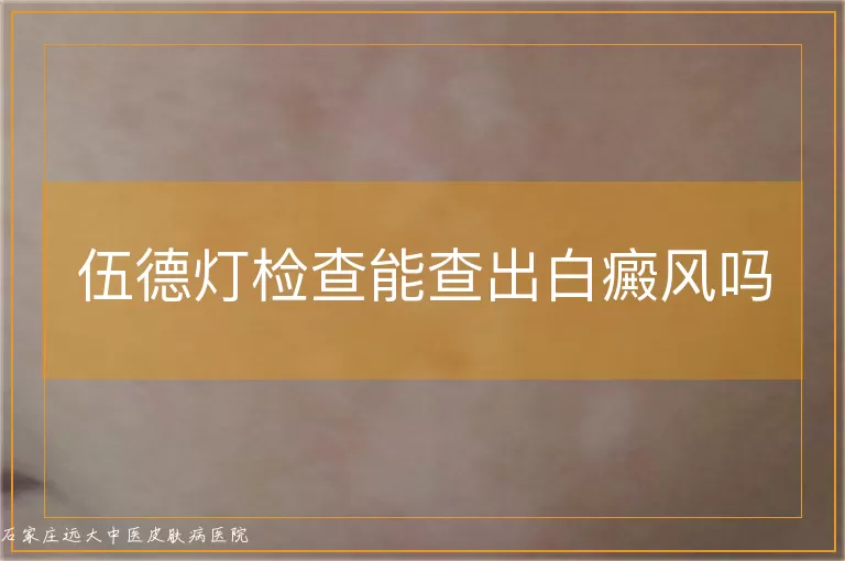 伍德灯检查能查出白癜风吗