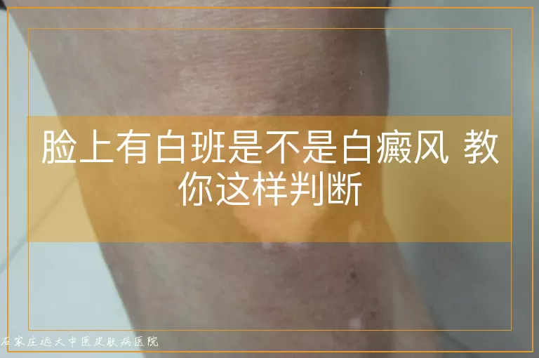 脸上有白班是不是白癜风 教你这样判断