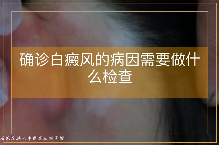 确诊白癜风的病因需要做什么检查