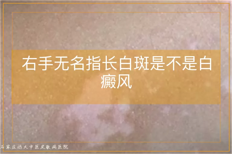 右手无名指长白斑是不是白癜风