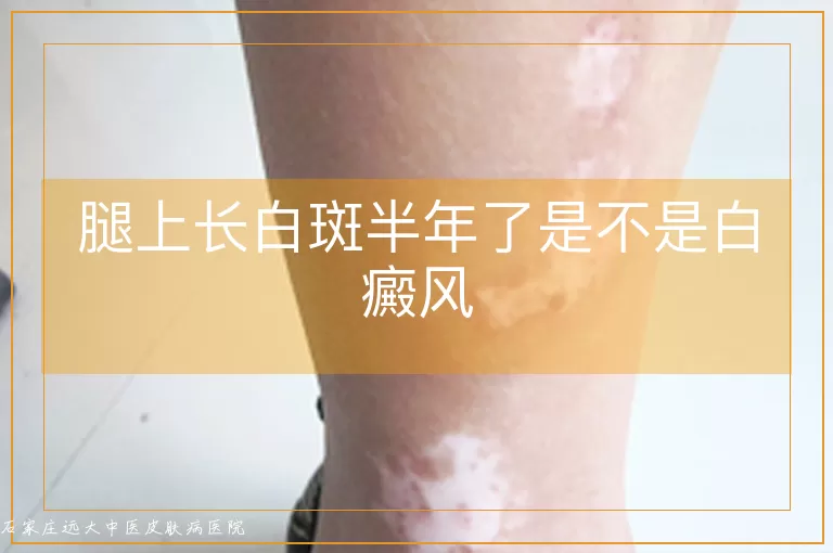 腿上长白斑半年了是不是白癜风
