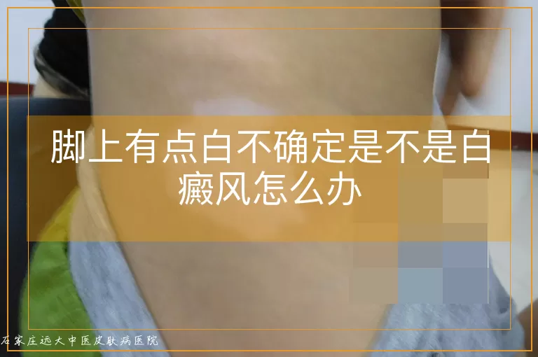 脚上有点白不确定是不是白癜风怎么办