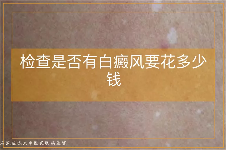 检查是否有白癜风要花多少钱