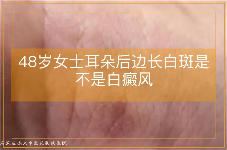 48岁女士耳朵后边长白斑是不是白癜风