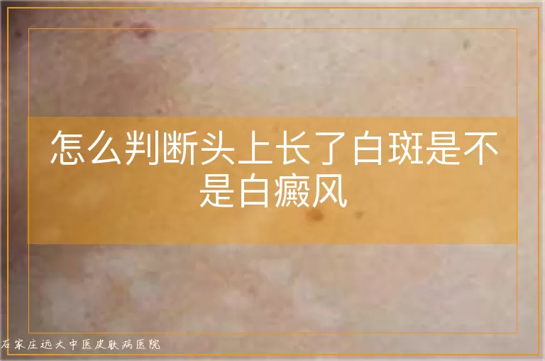 怎么判断头上长了白斑是不是白癜风