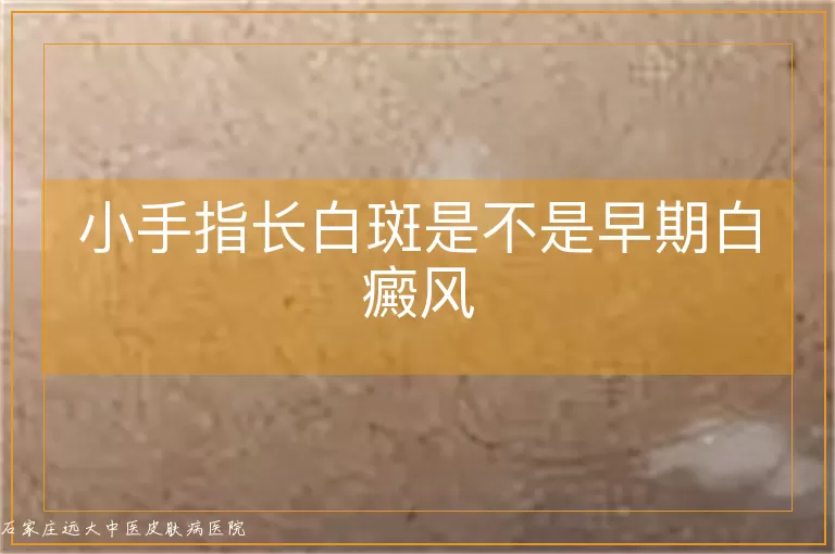 小手指长白斑是不是早期白癜风