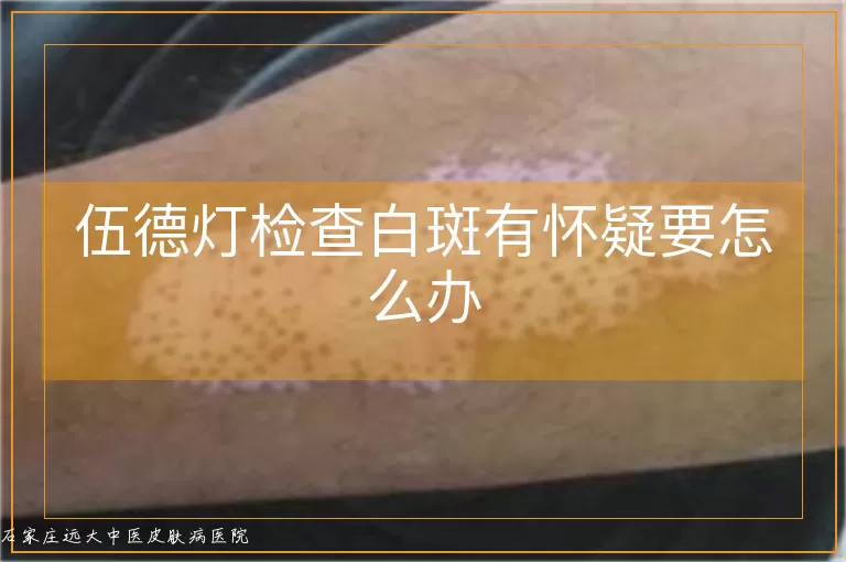 伍德灯检查白斑有怀疑要怎么办