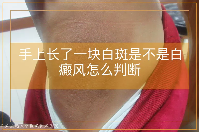 手上长了一块白斑是不是白癜风怎么判断