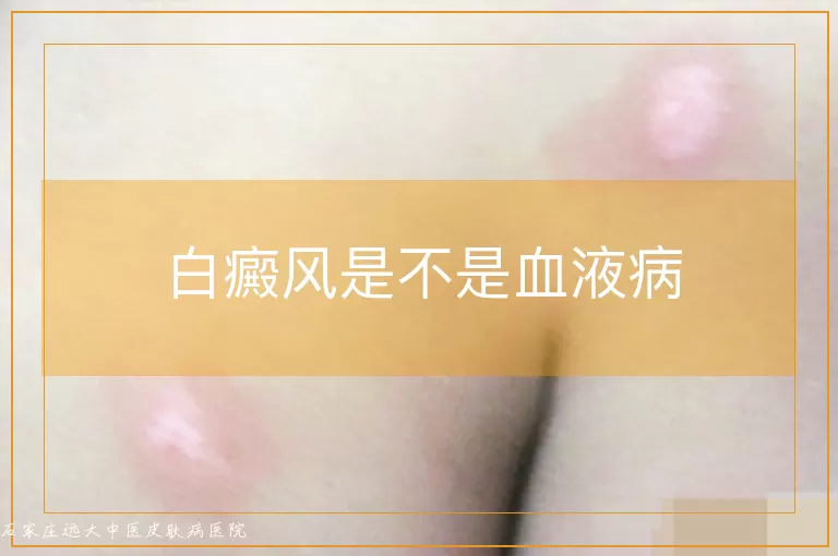 白癜风是不是血液病