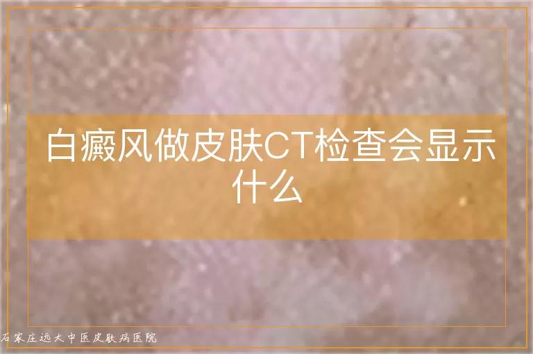 白癜风做皮肤CT检查会显示什么