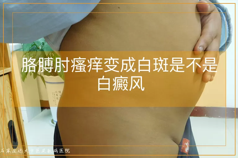 胳膊肘瘙痒变成白斑是不是白癜风