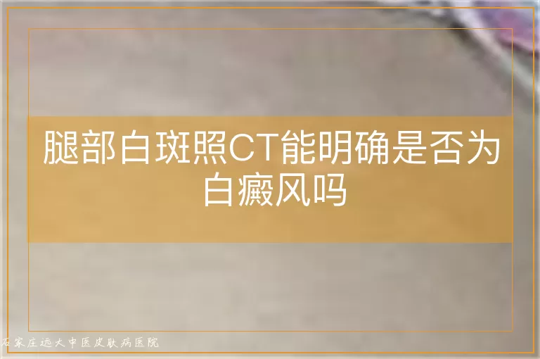 腿部白斑照CT能明确是否为白癜风吗