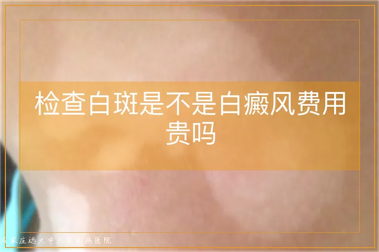 检查白斑是不是白癜风费用贵吗