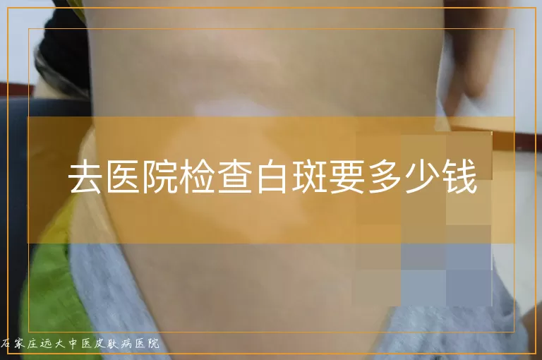去医院检查白斑要多少钱
