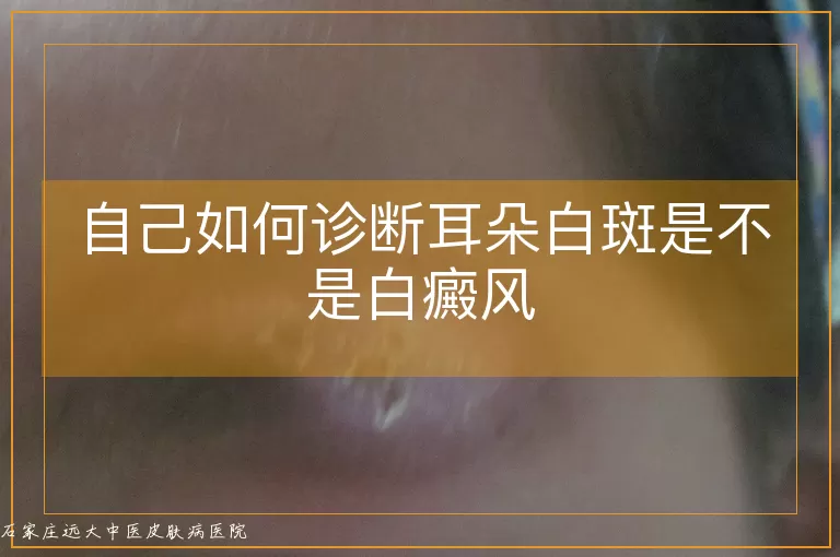 自己如何诊断耳朵白斑是不是白癜风