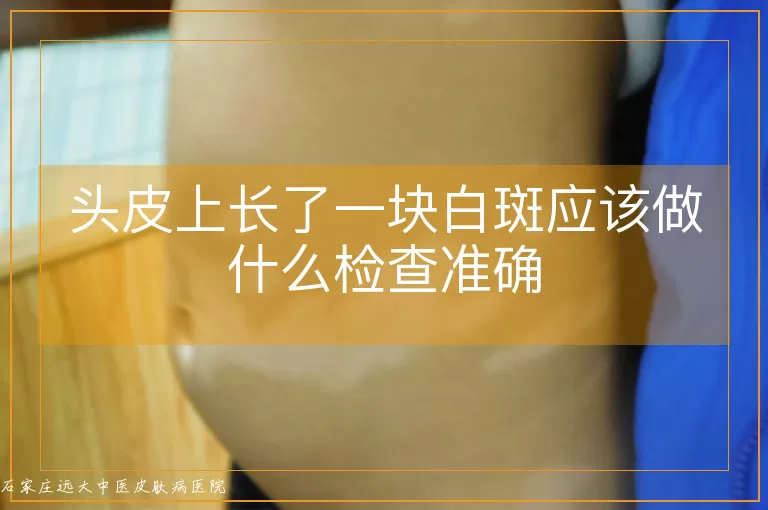 头皮上长了一块白斑应该做什么检查准确