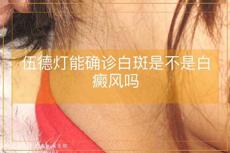伍德灯能确诊白斑是不是白癜风吗