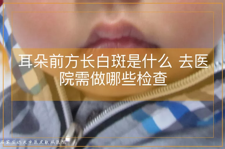 耳朵前方长白斑是什么 去医院需做哪些检查