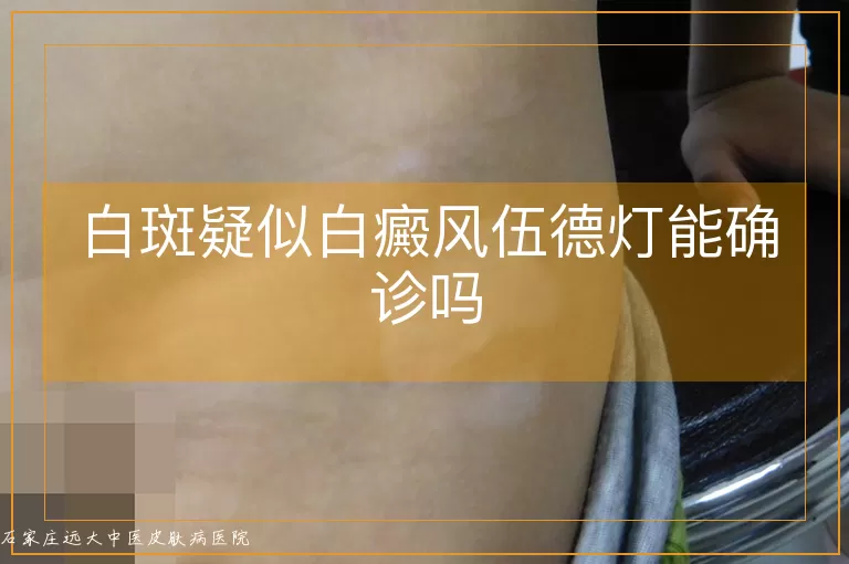 白斑疑似白癜风伍德灯能确诊吗