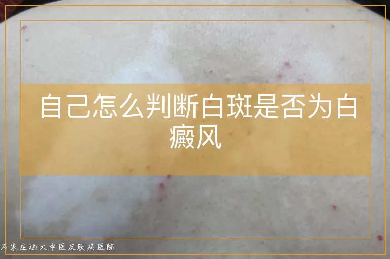 自己怎么判断白斑是否为白癜风