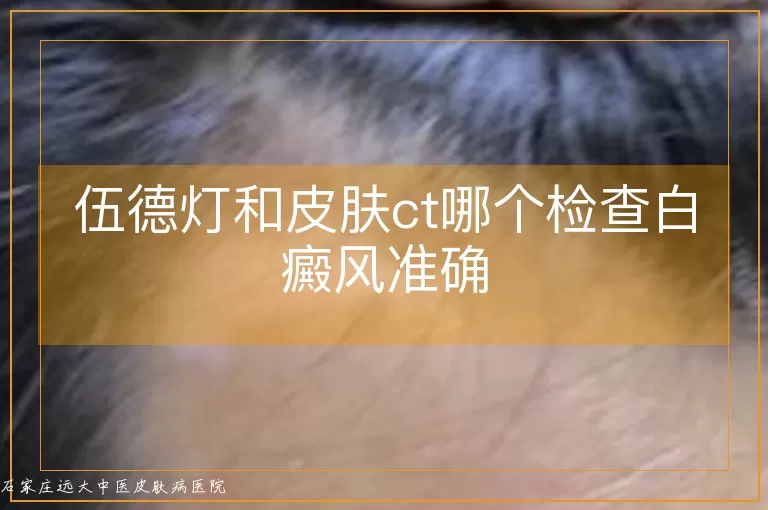 伍德灯和皮肤ct哪个检查白癜风准确