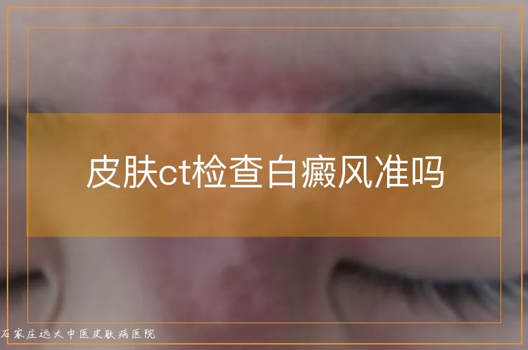 皮肤ct检查白癜风准吗