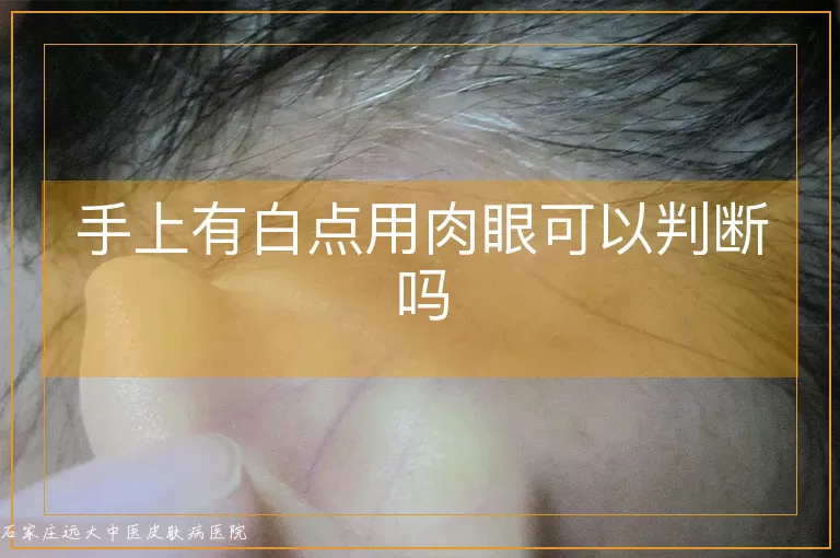 手上有白点用肉眼可以判断吗
