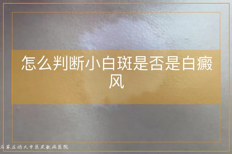 怎么判断小白斑是否是白癜风