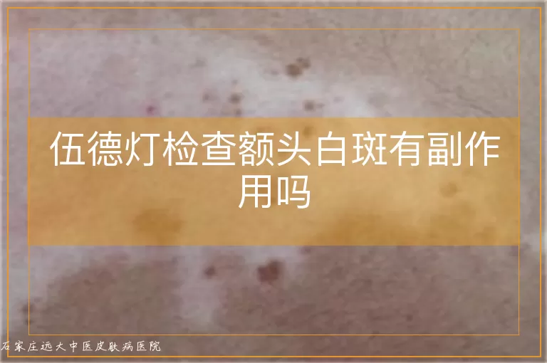 伍德灯检查额头白斑有副作用吗