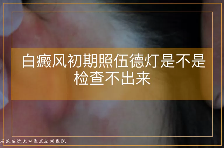 白癜风初期照伍德灯是不是检查不出来