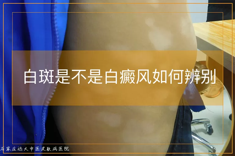 白斑是不是白癜风如何辨别