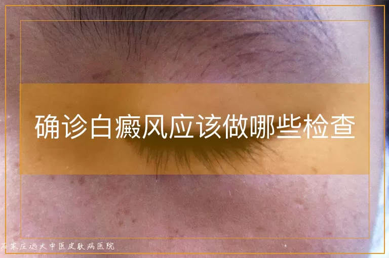 确诊白癜风应该做哪些检查