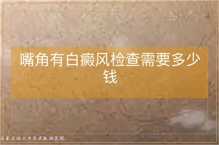 嘴角有白癜风检查需要多少钱