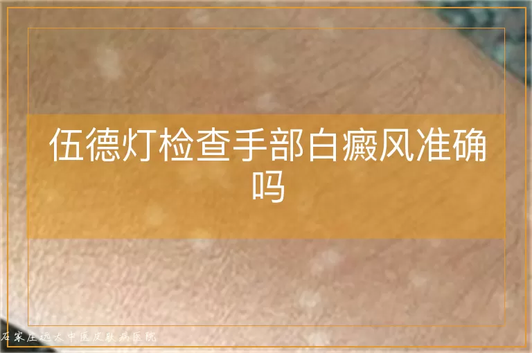 伍德灯检查手部白癜风准确吗