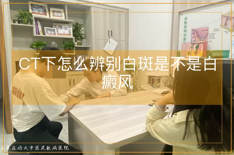 CT下怎么辨别白斑是不是白癜风